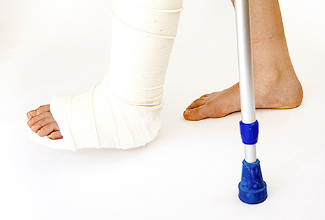 Imagem em plano fechado mostra os pés de uma pessoa caminhando. Um dos pés está engessado e o outro está descalço. É possível ver também a extremidade de uma bengala de alumínio que serve de suporte para a pessoa acidentada